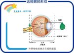 遠(yuǎn)視眼的形成
