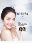 自体脂肪填充美女