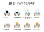 根管的治疗步骤