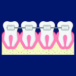 牙科医院镶牙补牙矫正牙齿示意图