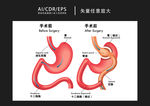 矢量医学肺部手术图解插画