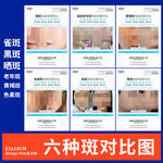 祛斑对比图 水光 面部管理