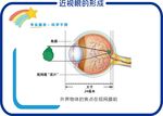 近视眼的形成