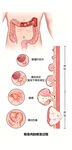 大肠息肉癌变演变图片