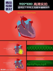 室性心动过速心室颤动演示动画