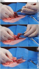 医生做手术取出异物