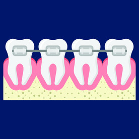 牙科医院镶牙补牙矫正牙齿示意图