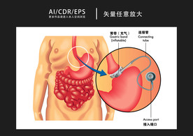 矢量医学肥胖肺部图解插画