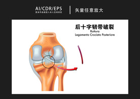 矢量医学骨折图解插画