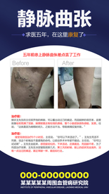 静脉曲张 下肢静脉曲张