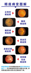 眼底病变图解