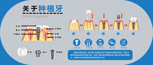 关于种植牙