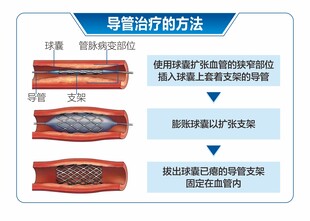 动脉硬化闭赛症导管治疗