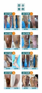 静脉曲张案例图