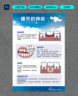 镶牙的种类